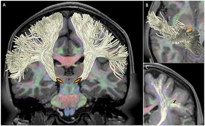 Somatotopic Organization of Hyperdirect Pathway Projections From the Primary Motor Cortex in the Human Brain